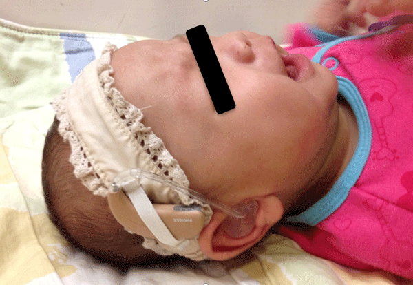 圖二：將助聽器固定在頭帶上可避免嬰兒躺著的時候產生回饋音。（圖片取自本會編著之「聽見問題：聽覺損傷兒童父母常見的問題與解答」）