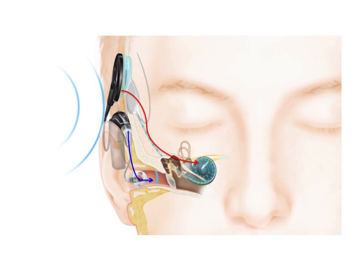 圖二 聲電混合剌激電子耳的聲音傳送方式；紅色箭頭為電流刺激、藍色箭頭為聲學刺激（圖片來源：www.cochlear.com）。