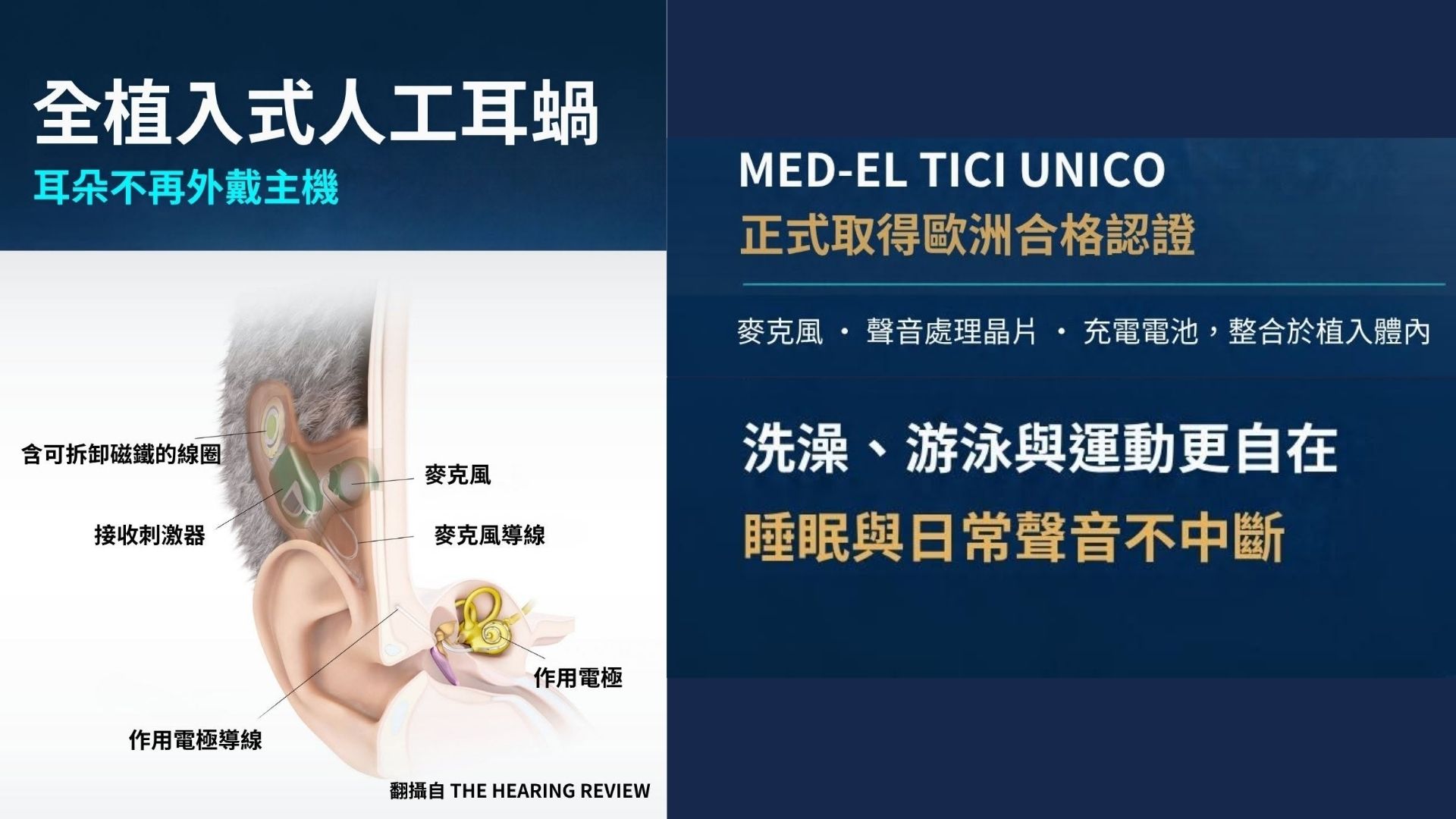 資訊圖介紹 MED-EL TICI UNICO 全植入式人工耳蝸系統，強調其完全整合於體內、不需外戴主機的特性。左圖解剖顯示皮下線圈、麥克風、處理器與耳蝸電極的位置。右圖列出產品獲得歐洲合格認證，並指出其防水、無須取下即可進行洗澡、游泳、運動與睡眠的優勢。